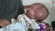 Rođenje bebe sa dva lica izazvala pometnju u Indoneziji