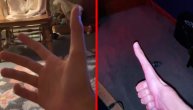 Upoznajte Džejkoba, momka sa najdužim palcem na svetu