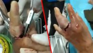 Doktori joj isekli prsten da joj spasu prst, reakcija ih šokirala