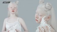 Albino manekenku svi zvali čudakinjom, danas ceo svet misli da je prelepa