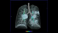 Skener 41-godišnje žene najbolje pokazuje na koji način korona virus uništava naša pluća