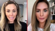 Horor neuspelog botoksa: Žena posle nedelju dana od tretmana dobila "lude oči"