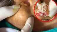Odvratno: Pustila 15 godina da joj bubuljice rastu jedna preko druge