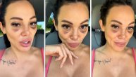 Tamara Đurić objavila snimak s modricama ispod očiju: Pokazala novi nos i kako izgleda bez šminke