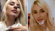 Ruža Rupić pala i udarila bradom: Pokazala kako izgleda povreda