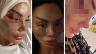 Ovako je starleta izgledala nakon operacije: Tamara Đurić u zavojima, potpuno otekla i puna modrica