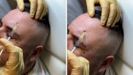 Snimak botoksiranja Filipa Cara: Uradio je stomak i čelo